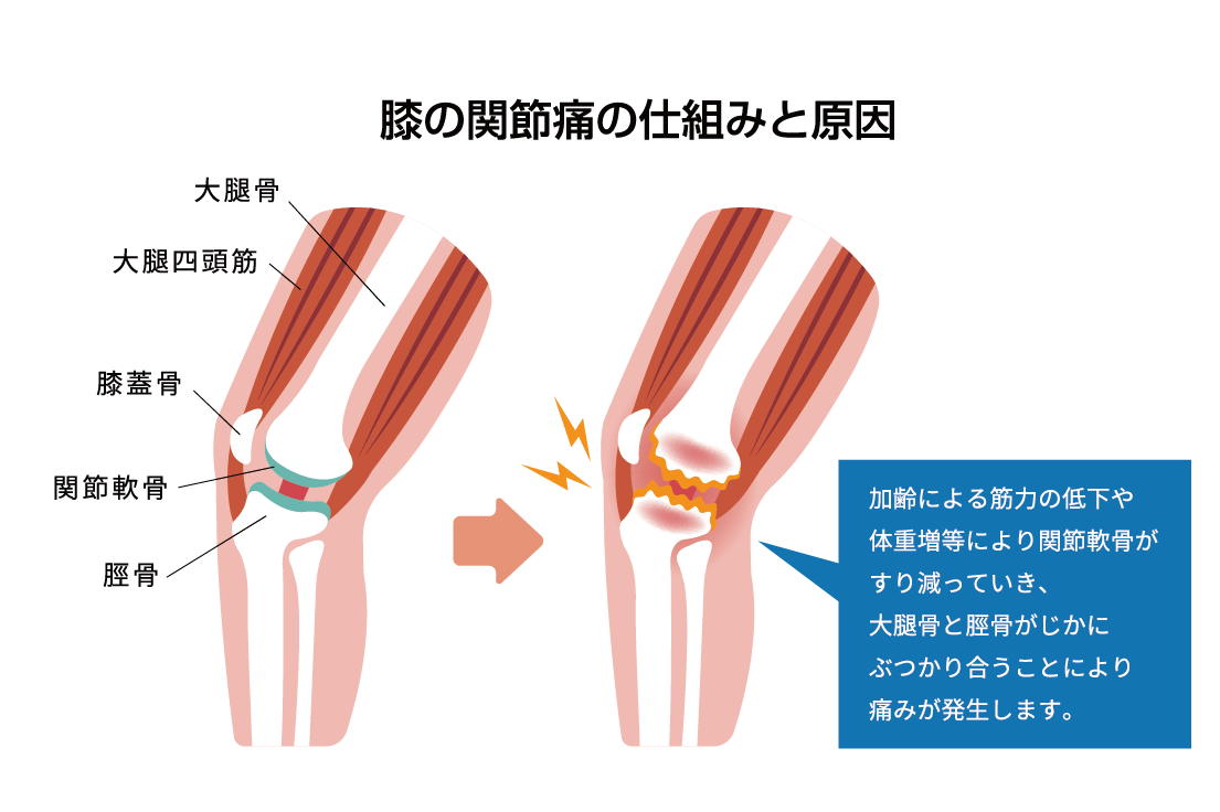 【膝の内側の痛み】4つの原因の見分け方と対処法・ストレッチをわかりやすく解説
