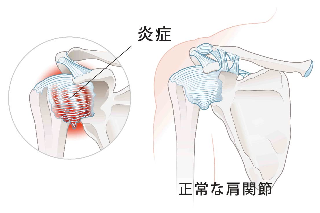 五十肩 腕 が 痛い