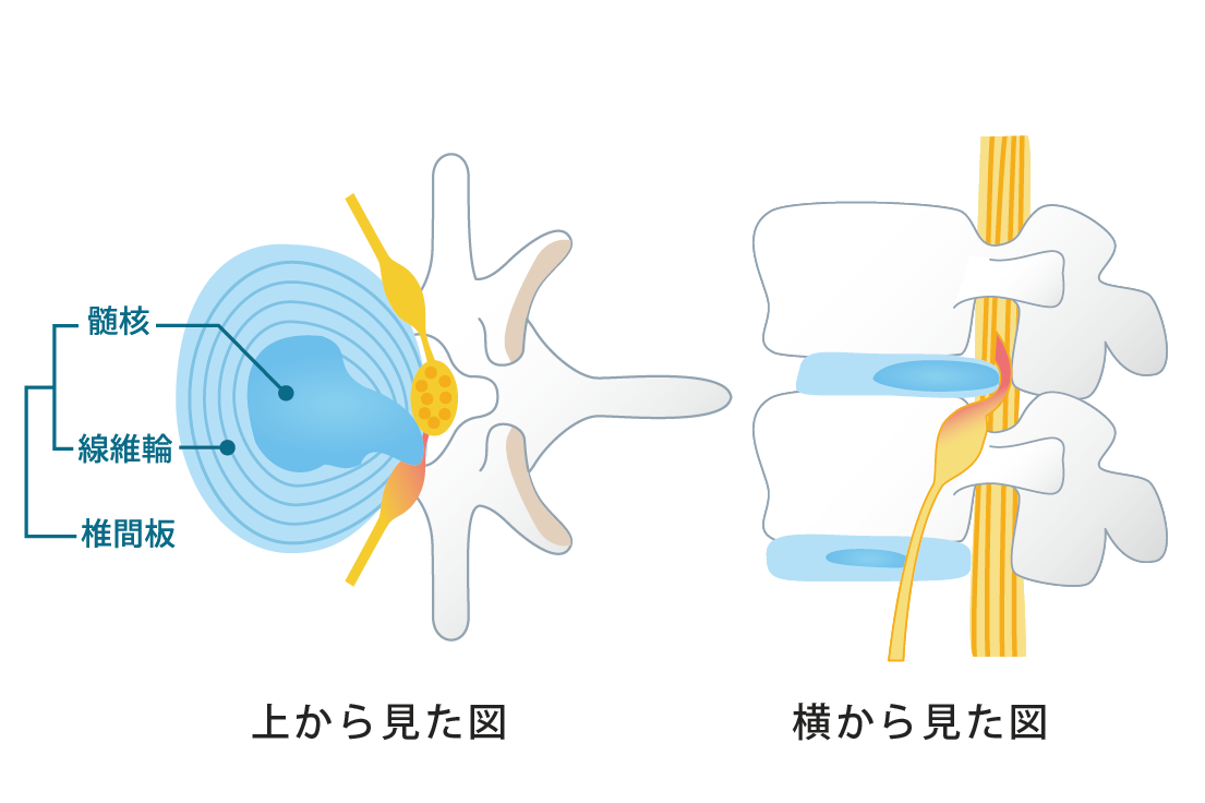 椎間板ヘルニアを防ぐ方法を知っていますか？