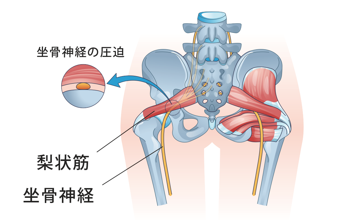 腰から片側の足にかけての痛み】坐骨神経痛の原因と3つの対処法