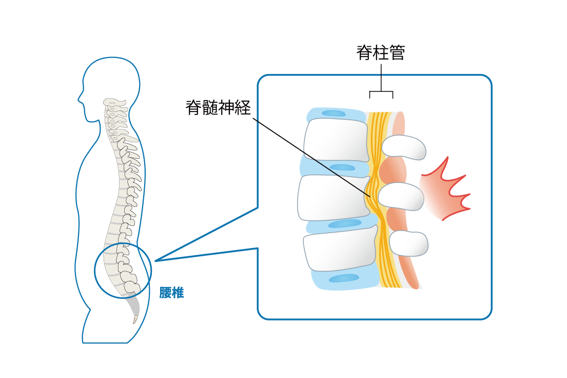 腰痛 神経痛 などに 痛み・凝り・痺れる症状 | NAO鍼灸院