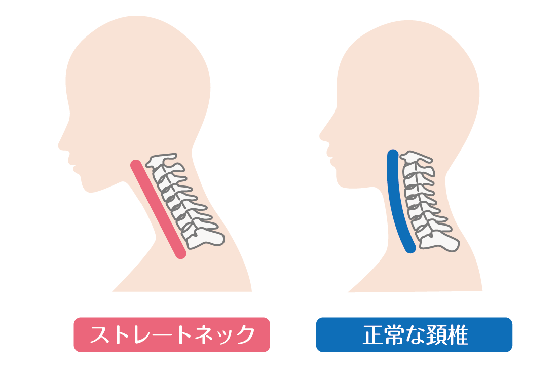 首が痛い時の楽な寝方とは？姿勢別に負担の掛からない方法をポイント 