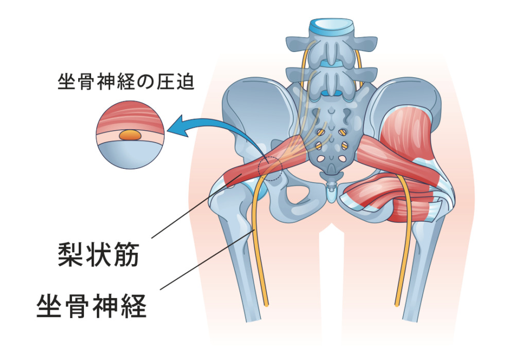 梨状筋症候群でやってはいけない行動リスト｜悪化を防ぐ5つの