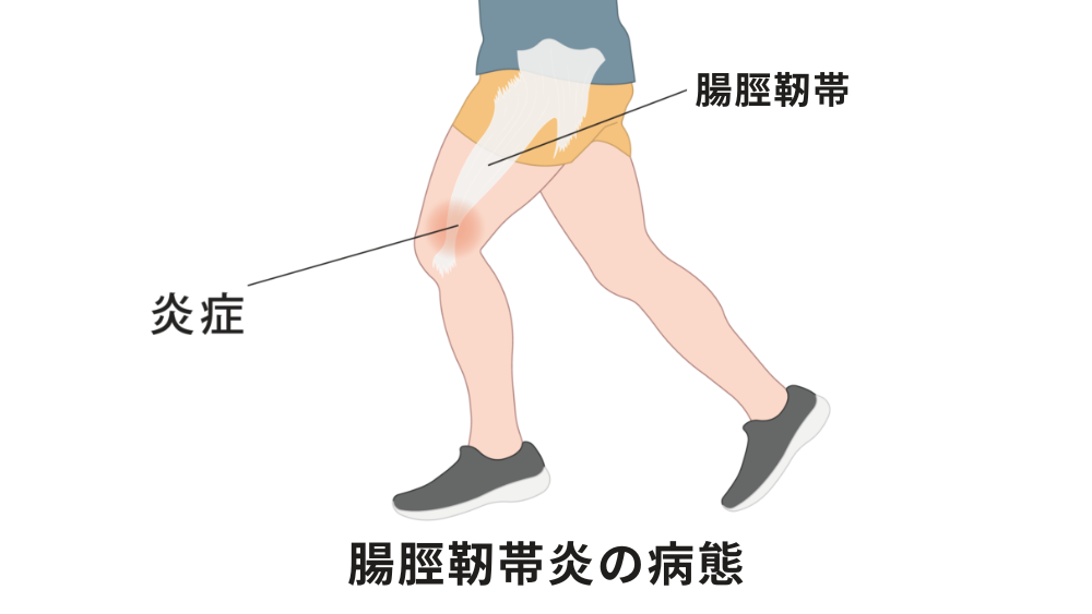 【膝の外側が痛い】痛みの原因とストレッチなどの対処法について詳しく解説! - 株式会社リハサク