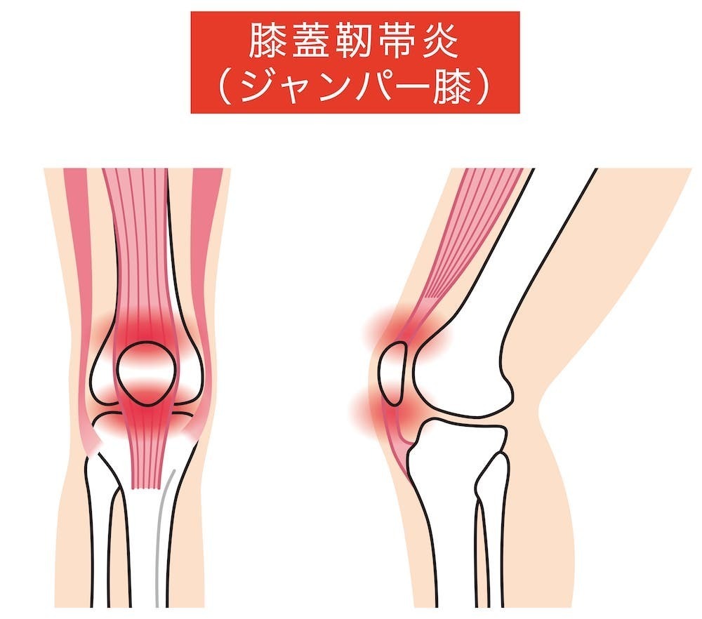 膝 テーピング 巻き 方