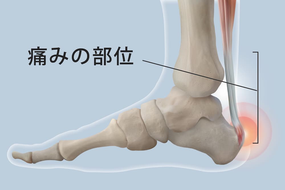 アキレス腱が痛い】アキレス腱炎の症状や痛みを改善するセルフケアを
